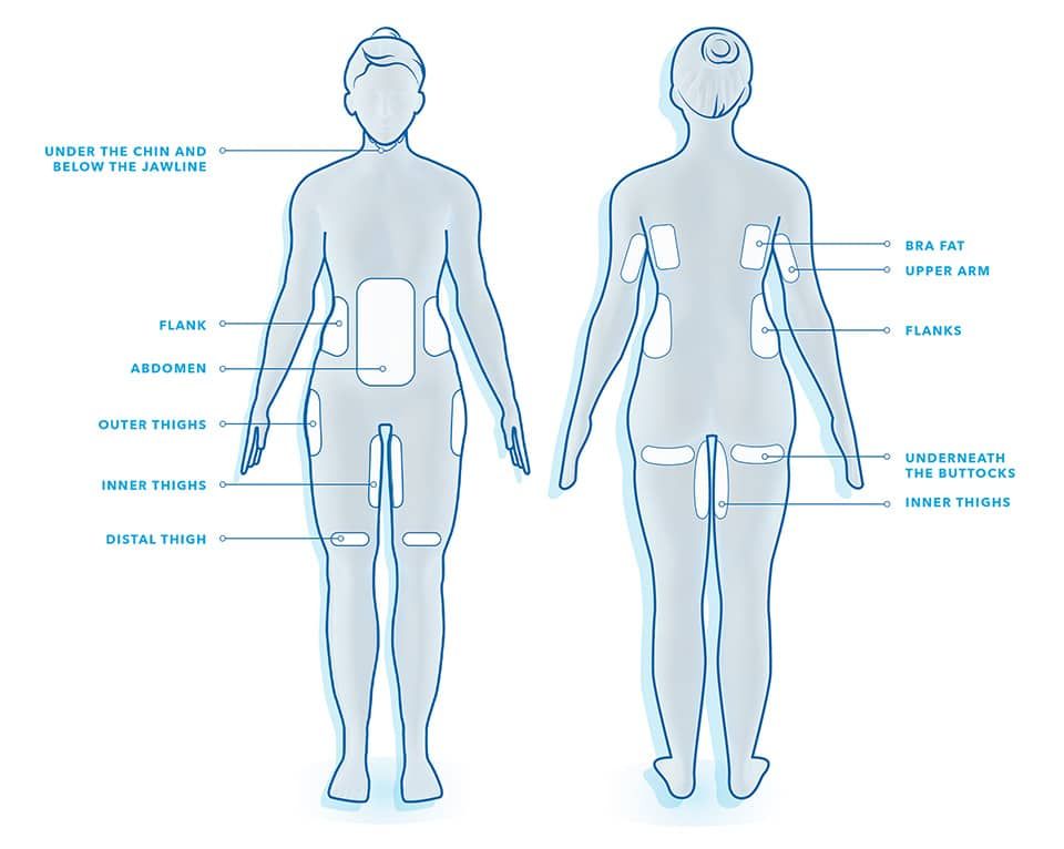Body areas for fat reduction and contouring guidance.