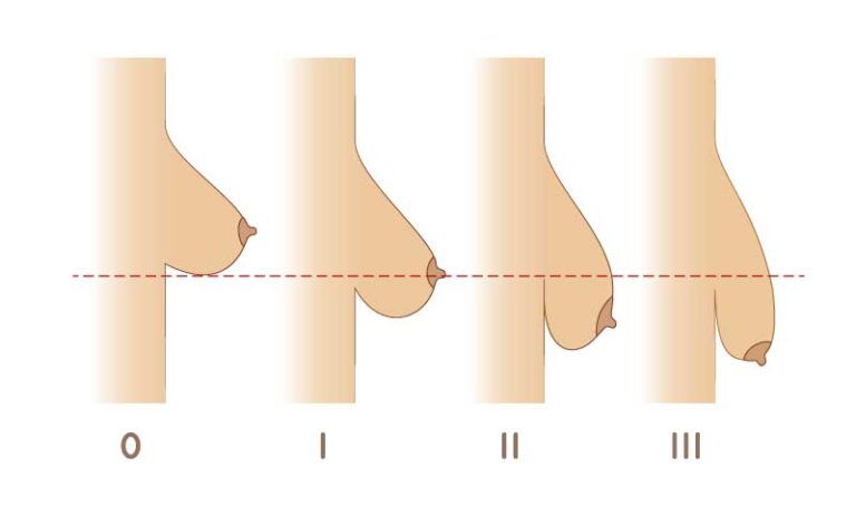 Breast classification illustration showing different stages.