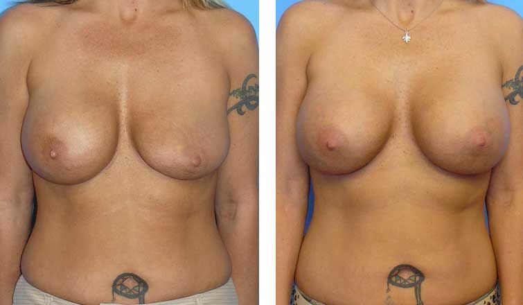 Before and after breast augmentation comparison photo.