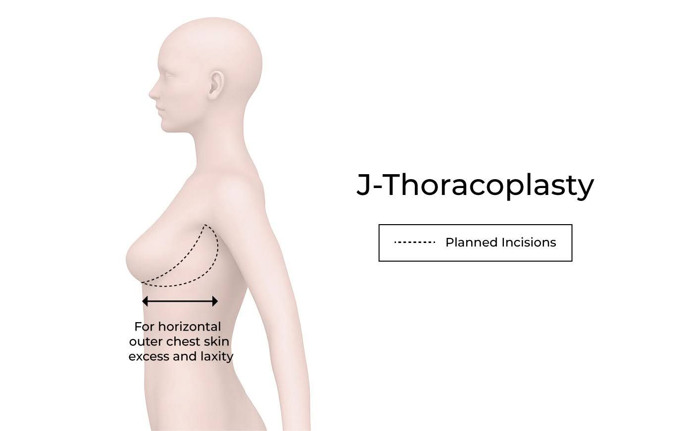 J-Thoracoplasty diagram illustrating planned incisions.