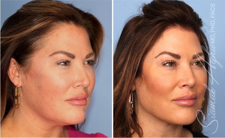 Before and after profile comparison of cosmetic treatment.