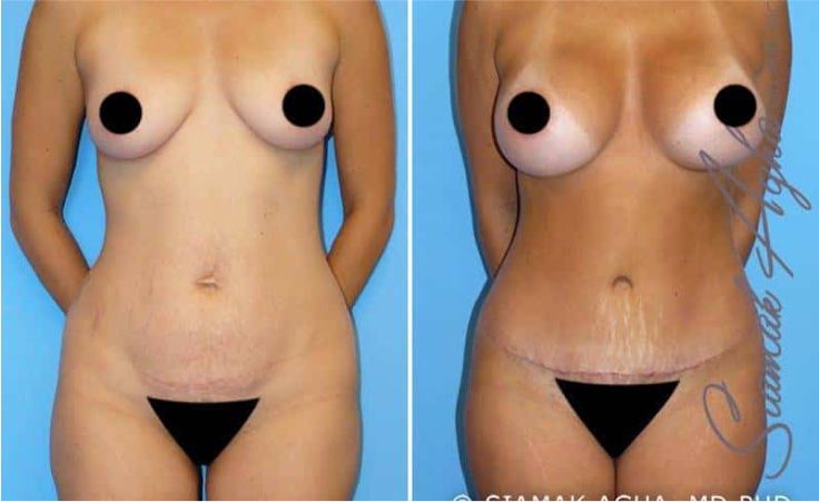 Before and after body contouring results.