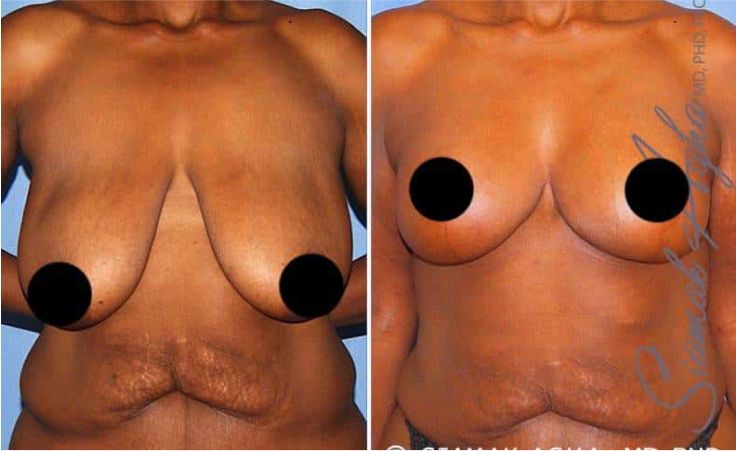Before and after breast enhancement comparison image.