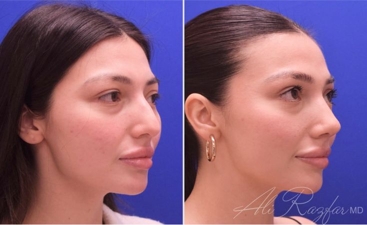 Before and after profile view of a woman.