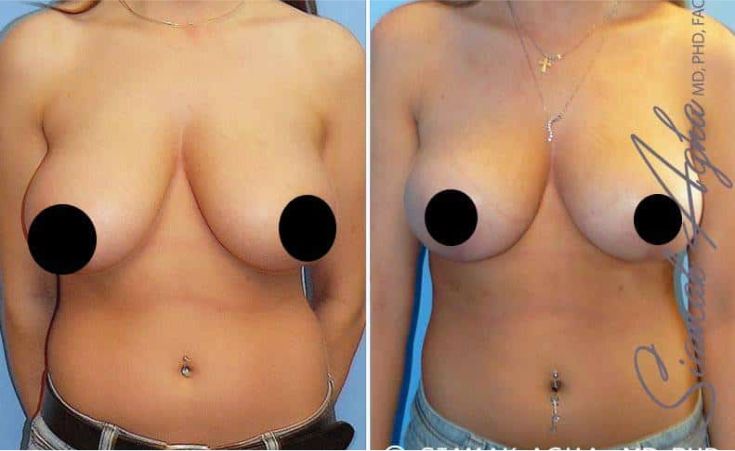 Before and after cosmetic breast procedure images.