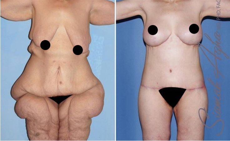 Before and after body transformation comparison.