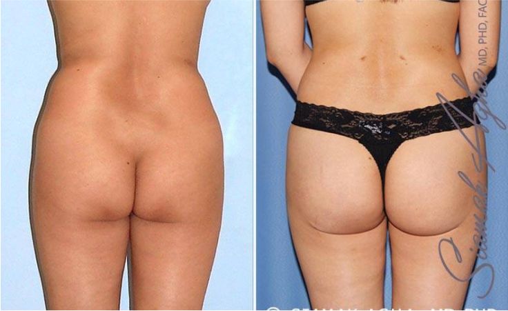 Before and after body contouring results.
