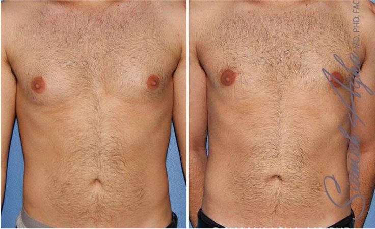 Before and after body shaping results.
