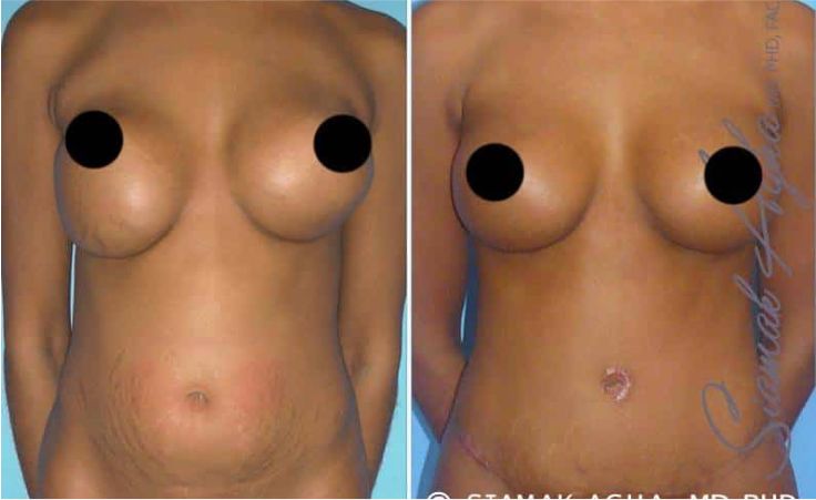 Before and after breast enhancement images