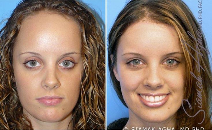Before and after facial transformation photos.