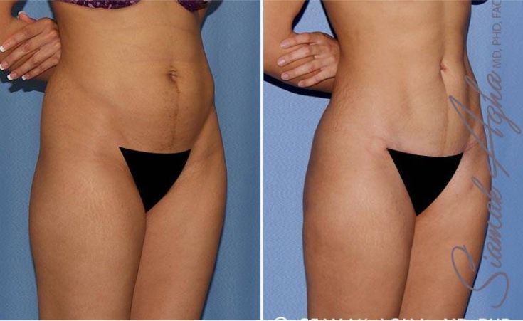 Before and after body contouring results.