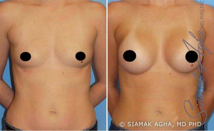 Before and after breast enhancement images.