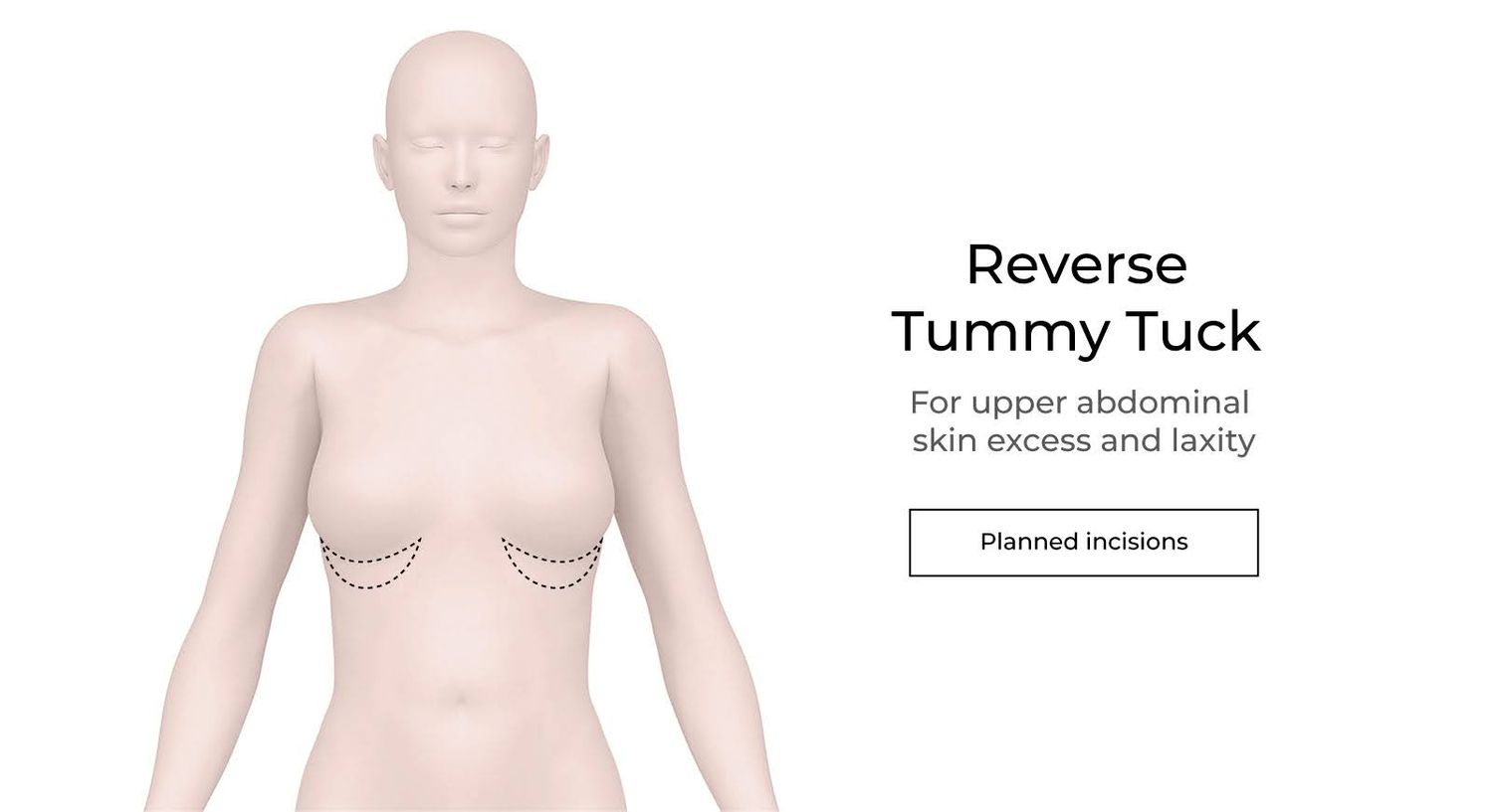 Illustration of reverse tummy tuck procedure incisions.