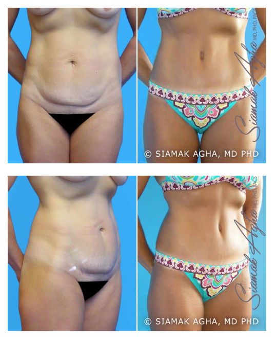 Before and after body contouring results.
