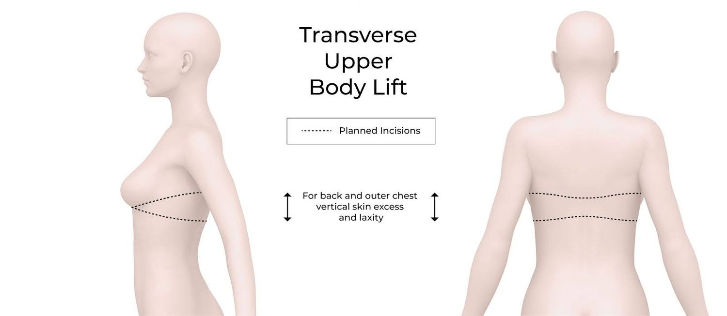 Transverse upper body lift diagram with incisions.