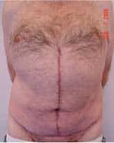 Abdominoplasty