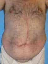 Abdominoplasty