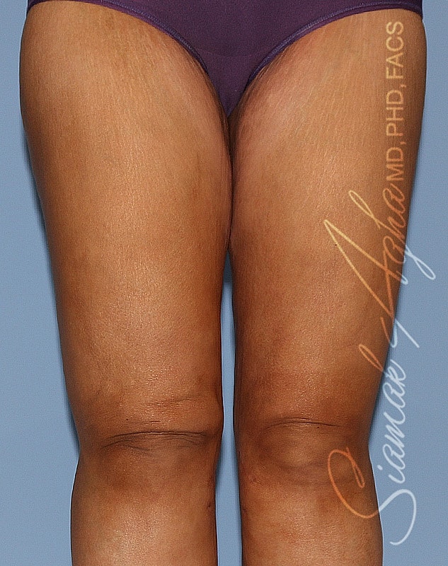 Close-up of female thighs in purple briefs.