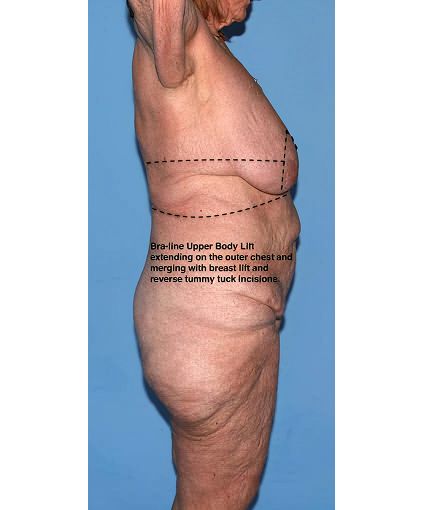 Side view of bra-line upper body lift technique.