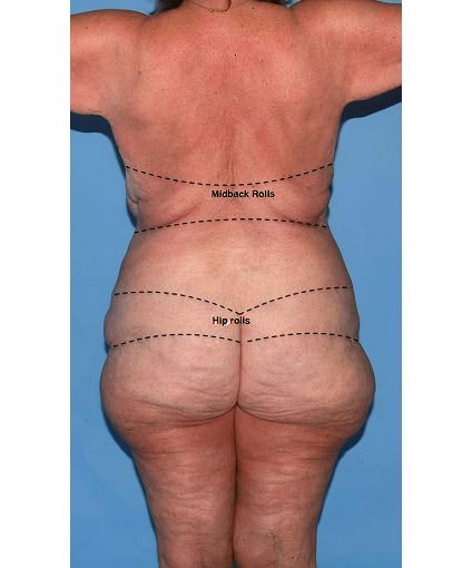 Body illustration highlighting midback and hip rolls.