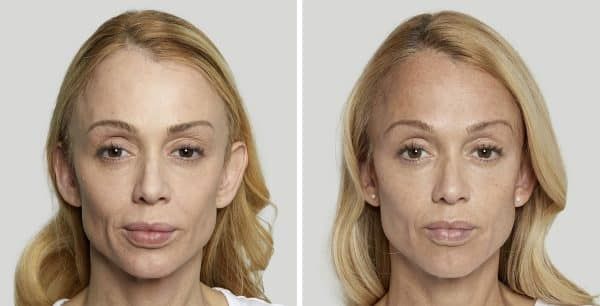 Before and after facial treatment comparison.