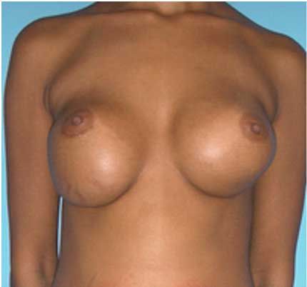 Secondary Breast Augmentation Newport Beach