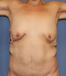Body image with surgical markings on chest.