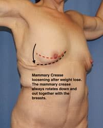 Mammary crease changes after weight loss.
