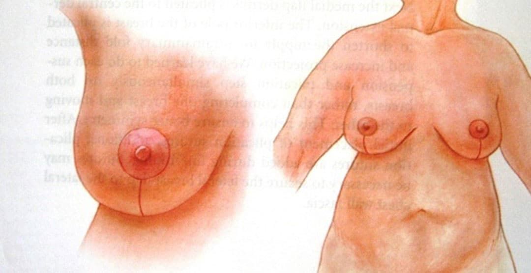 Breast Enhancement
