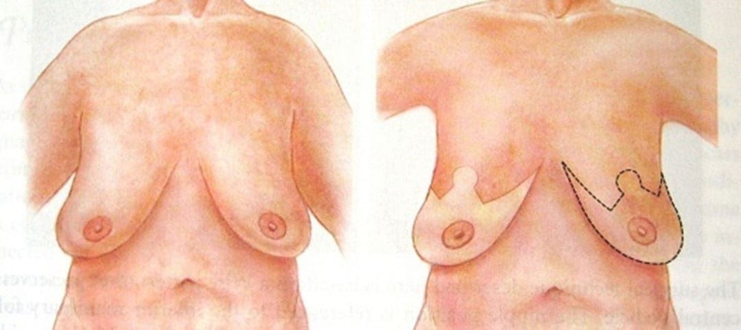 Breast Enhancement