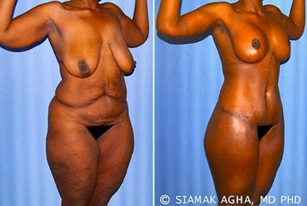 Breast Enhancement