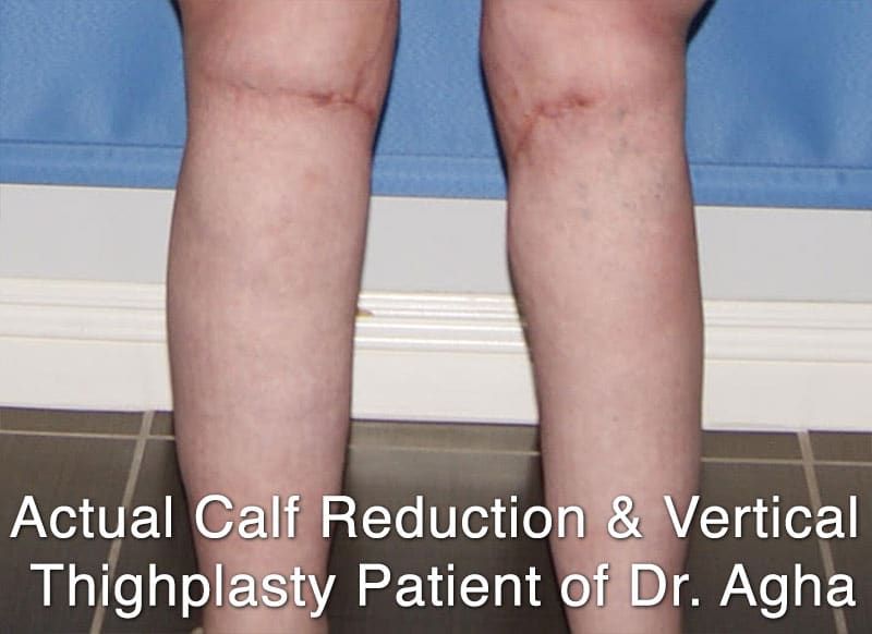 Calf Reduction Surgery