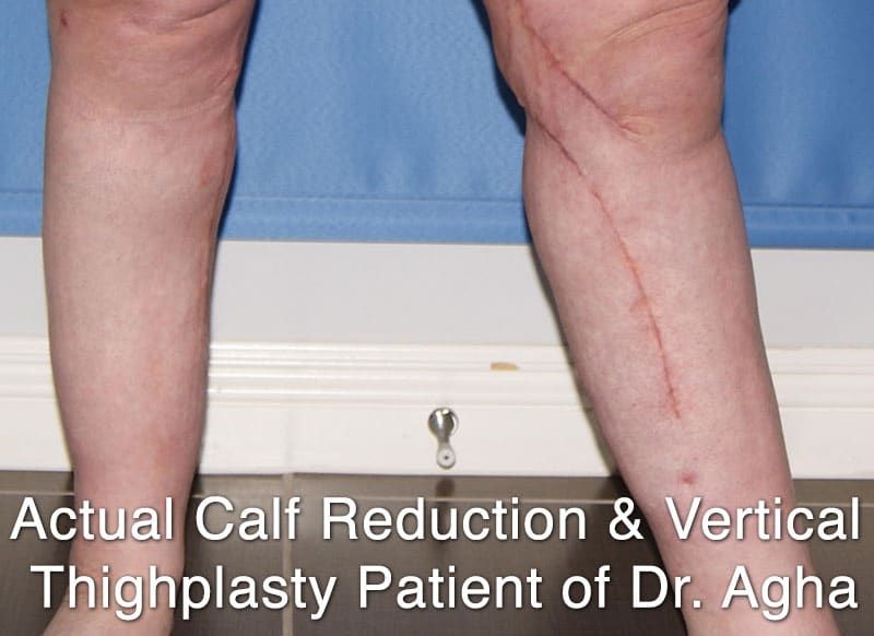 Calf Reduction Surgery