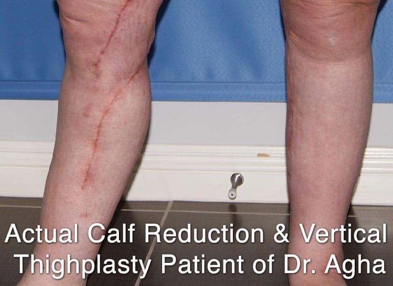 Calf Reduction Surgery