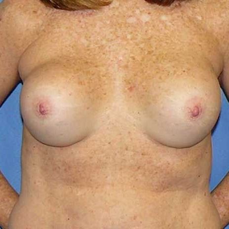 Secondary Breast Augmentation Newport Beach