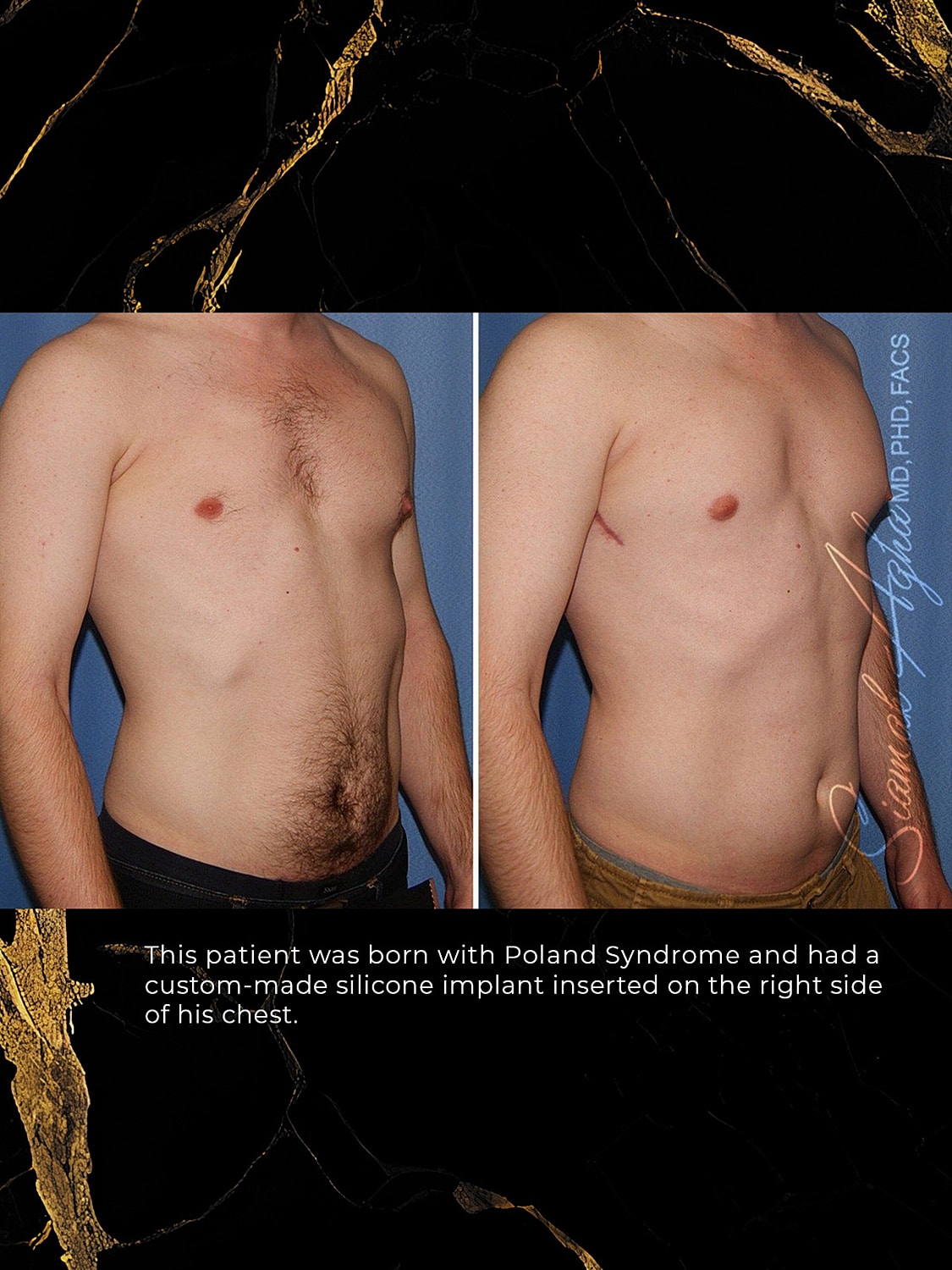 Chest photos showing surgery due to Poland Syndrome.