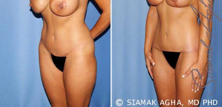 Before and after body contouring surgery comparison.