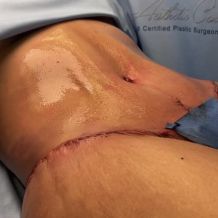 Post-operative surgical site on abdominal area.