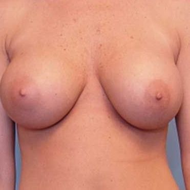 Nude torso showing breast anatomy.
