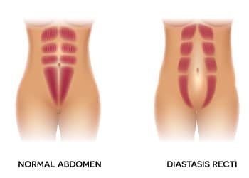 Comparison of normal abdomen and diastasis recti