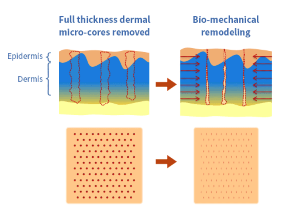 Skin treatment process and benefits explained.