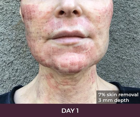 Day 1 of skin treatment procedure recovery.