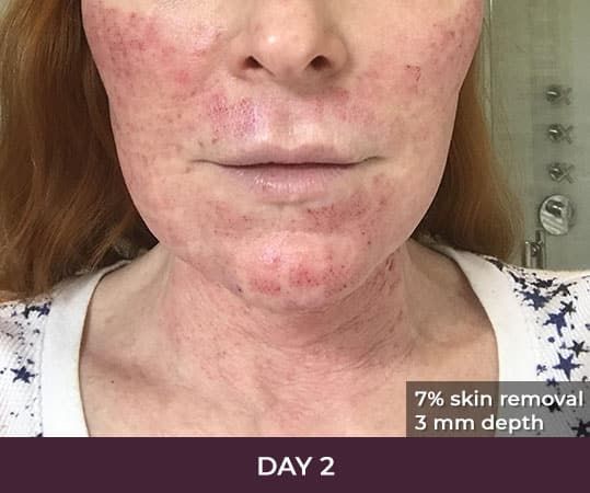 Post-procedure skin healing on day two.