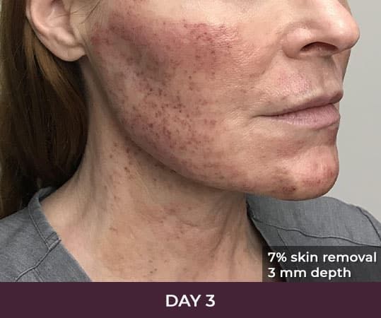 Skin treatment progress on day 3 post-procedure.
