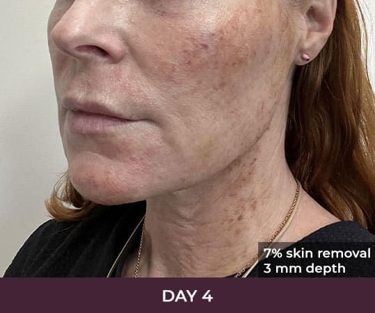 Skin treatment progress on day four.