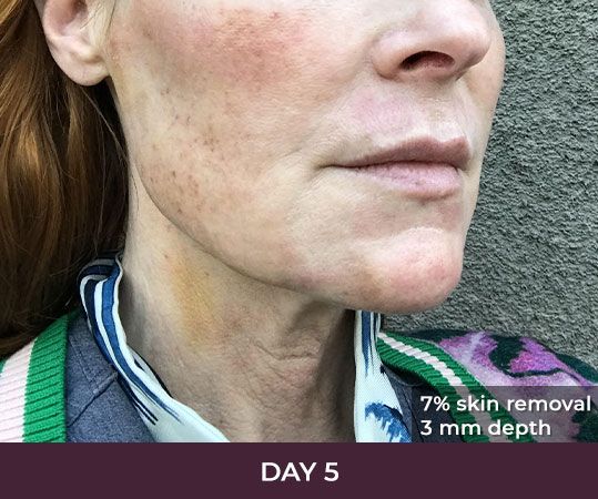 Skin treatment progress, day 5 after procedure.