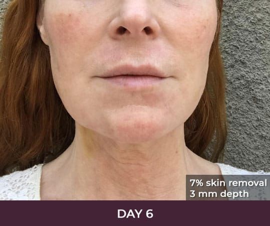 Skin treatment progress, day six post-procedure.