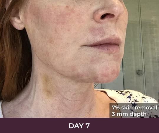 Skin treatment progress on day seven.