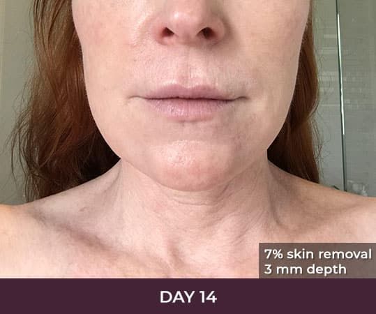 Face after skin treatment on day 14.
