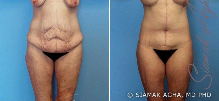 Before and after body contouring surgery results.